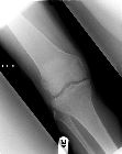 Lateral tibial plateau fracture