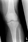 Lateral tibial plateau fracture