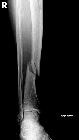 Maisonneuve fracture