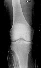 Maisonneuve fracture