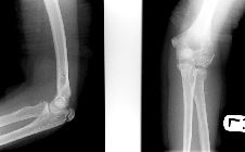 Osteochondritis dissecans - capitellum