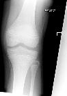 Avulsion fracture following dislocated patella