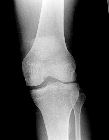 Rupture infrapatellar ligament