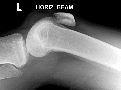 Rupture infrapatellar ligament