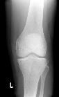 Segond fracture