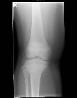 Segond fracture and fracture head of fibula