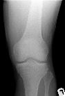 Segond fracture