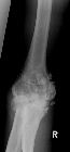 Synovial osteochondromatosis - elbow