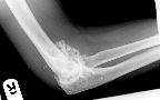 Synovial osteochondromatosis - elbow
