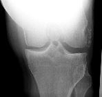 Synovial osteochondromatosis