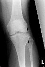 Fracture lateral tibial plateau