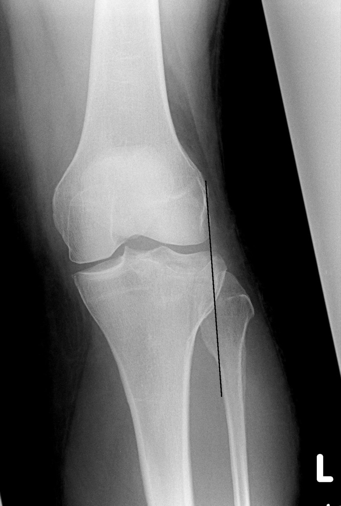 Lateral tibial plateau avulsion