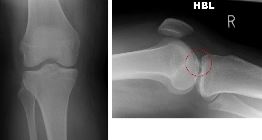 ACL avulsion fracture