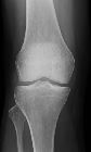 Osteochondritis dissecans