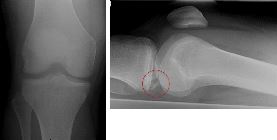 PCL avulsion fracture