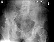 Right acetabular fracture with posterior dislocation, diastasis left SIJ, fracture left pubic rami