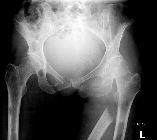 Pathological fracture through metastatic lesion