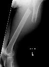 Pathological fracture through metastatic lesion