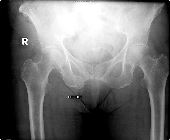 Right intertrochanteric fracture, old fracture inferior pubic ramus