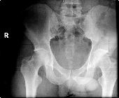 L5 transverse process fracture, left ileum fracture