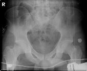 Fracture left sacrum, inferior pubic ramus