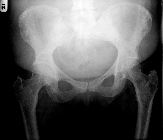 Bony metastases