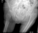 Missed subcapital fracture left NOF - 3 weeks later