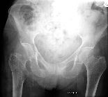 Missed subcapital fracture left NOF, right rami fractures - first attendance