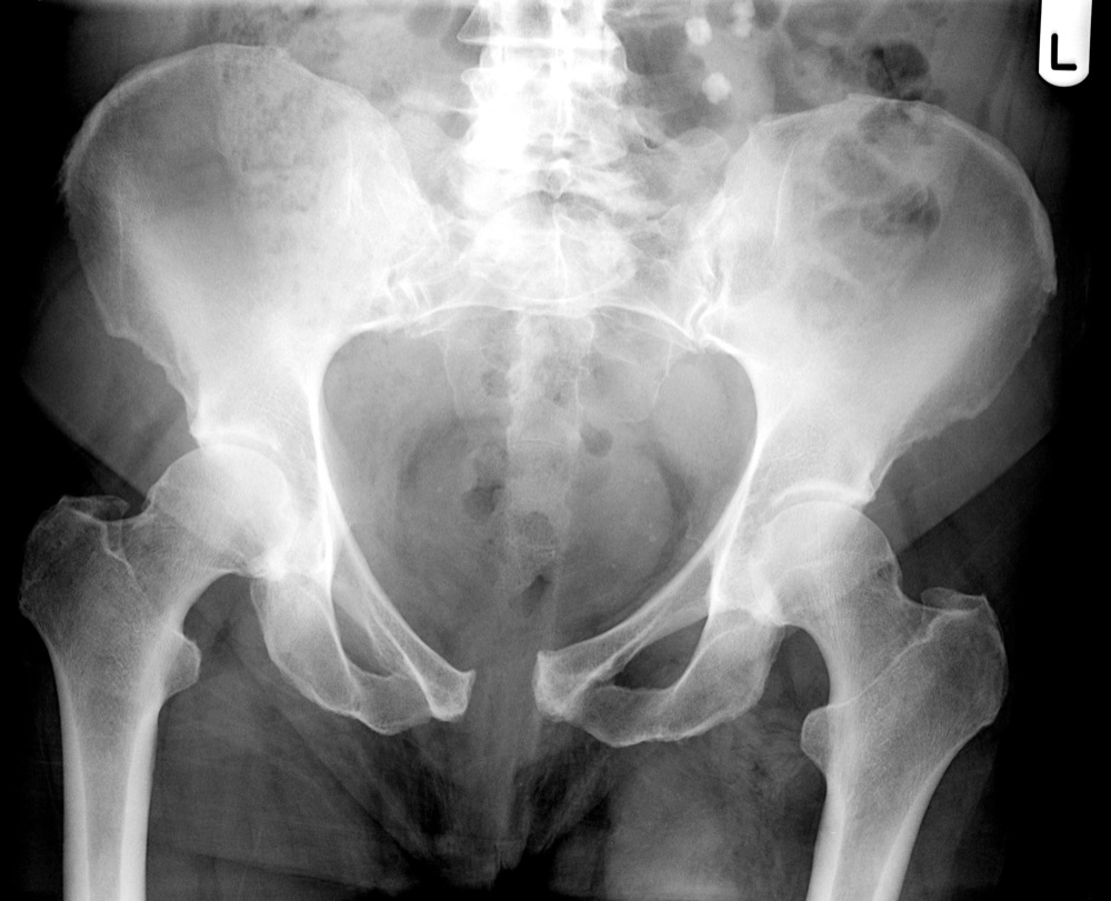 What are open book pelvic fractures?