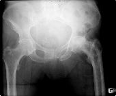 Paget's disease left femur