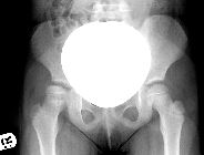 Perthes' right hip