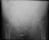 Subcapital fracture left neck of femur