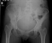 Fractures of the right pubic rami, fracture right ilium, fracture left sacrum