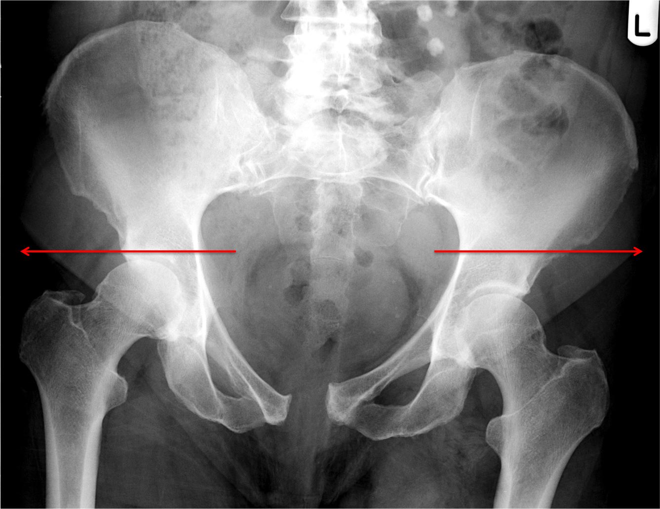 The morphological mapping of lateral compression type 1 pelvic fracture and pelvic  ring stability classification: a finite element analysis | Journal of  Orthopaedic Surgery and Research | Full Text