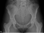 Avulsion right iliac crest