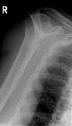 Clavicle, ribs, scapular fractures