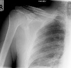 Clavicle, ribs, scapular fractures