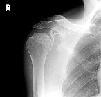 Post-reduction, Bankart lesion