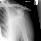 Anterior dislocation, Hill-Sachs defect