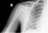 Normal paediatric shoulder