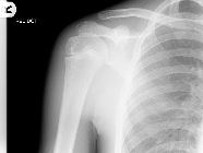 Normal paediatric shoulder