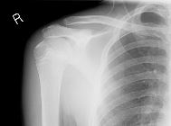 Normal paediatric shoulder