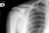 Normal paediatric shoulder