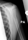 Metaphyseal fracture