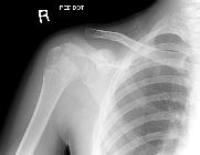 Metaphyseal fracture