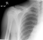 Fractured clavicle, normal ossification centres