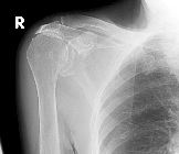 Rotator cuff tendonopathy