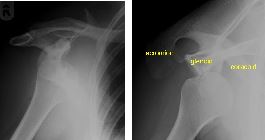 Anterior dislocation