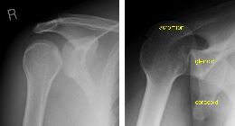 Posterior dislocation