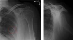 Fracture scapula blade